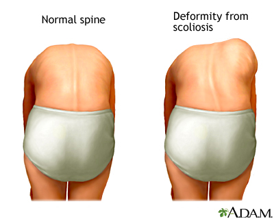 Normal spine vs deformity from scoliosis diagram